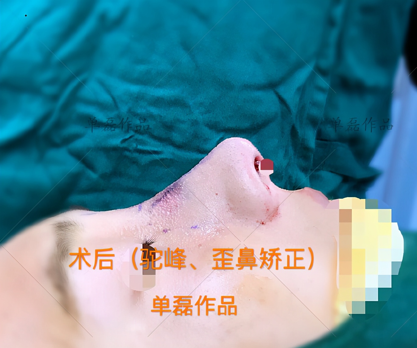 驼峰鼻怎么打鼻影,驼峰鼻用什么材料隆鼻