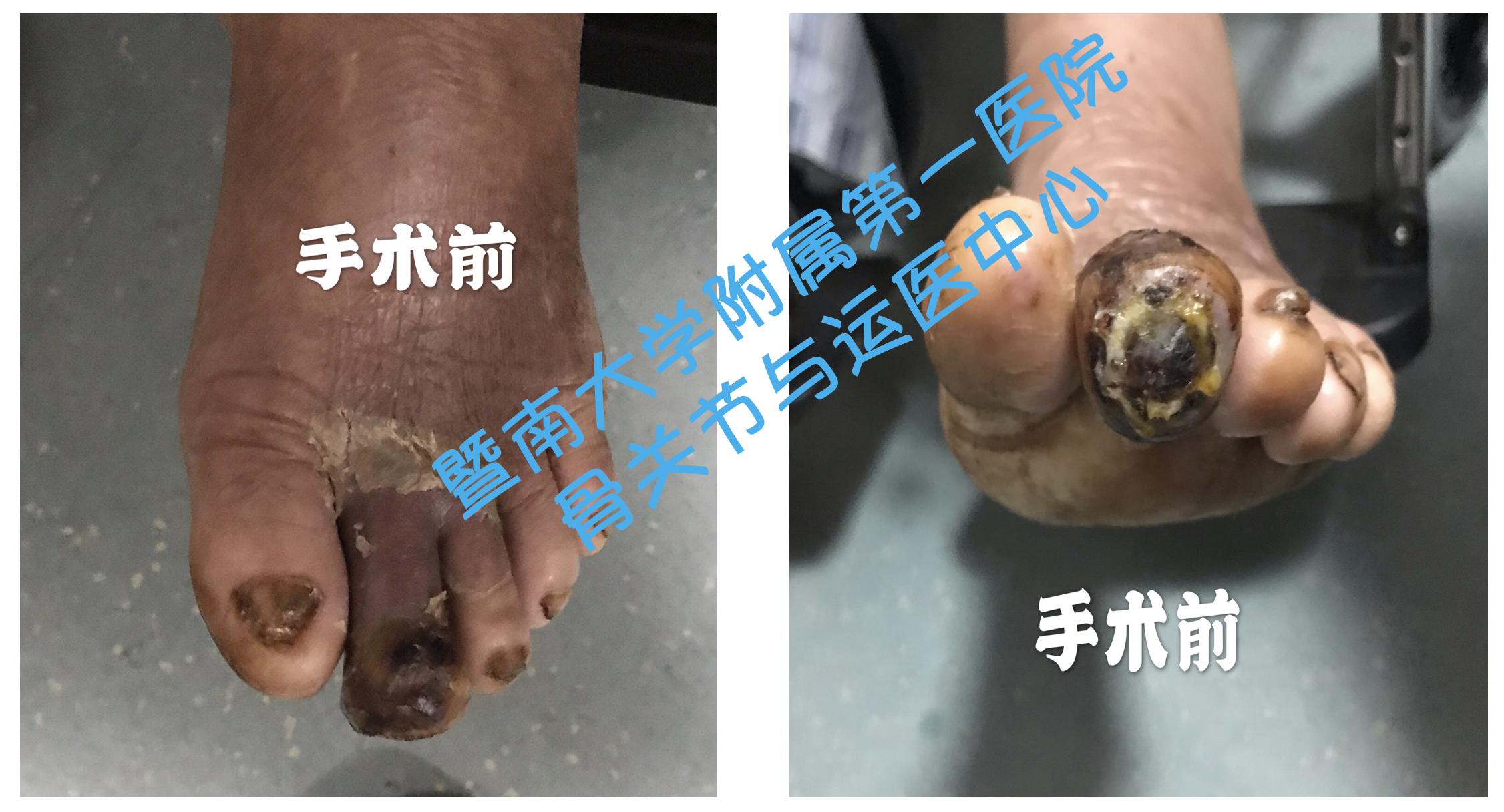 糖尿病足截肢后怎么长肉快,糖尿病足不截肢的最新疗法