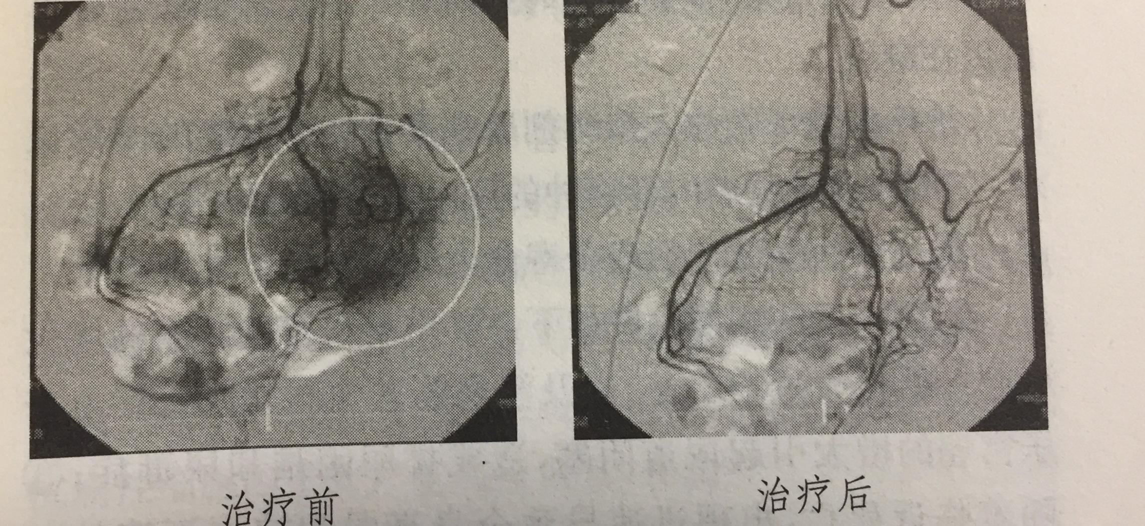 癌症患者免疫治疗的过程,癌症的介入治疗的风险与并发症