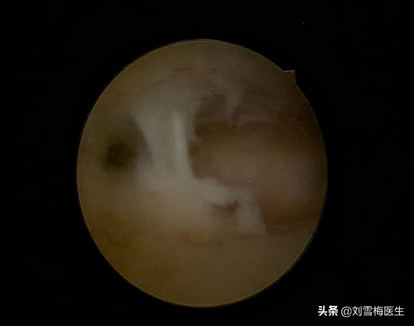 刘雪梅医生视频,刘雪梅大夫