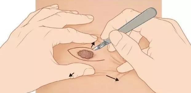 医生点痣,市人民医院能点痣吗