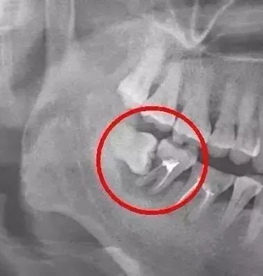 智齿向脸颊方向长一定要拔吗,40岁智齿横着长一定要拔吗