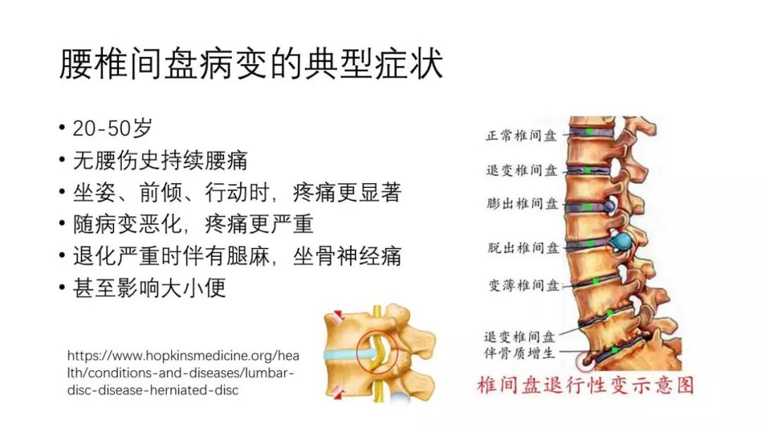 腰椎间盘突出坐骨神经痛如何缓解,腰椎间盘突出脚痛神经痛怎么缓解