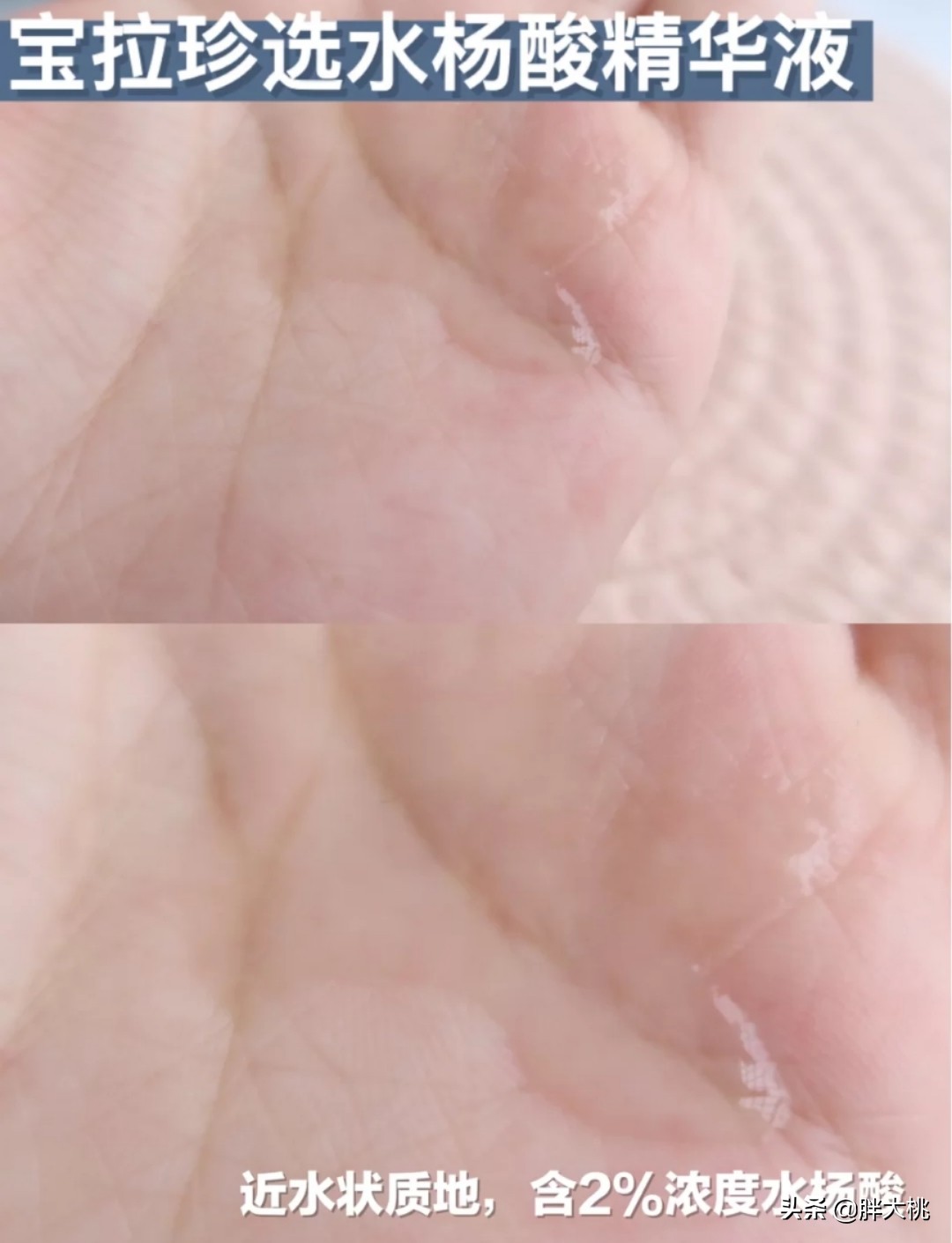 皮肤长黑头闭口刷酸真的可以吗,黑头刷酸有用吗能收缩毛孔吗