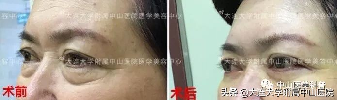 你有没有被自己的眼袋困扰过,关于眼袋的科普在这里