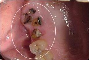 良心牙医不建议拔智齿残根,牙齿残根怎么处理视频