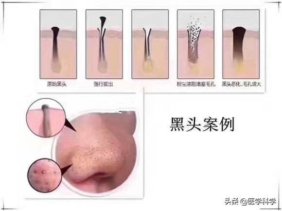 快速去黑头的最有效方法,去黑头最简单有效快捷方法