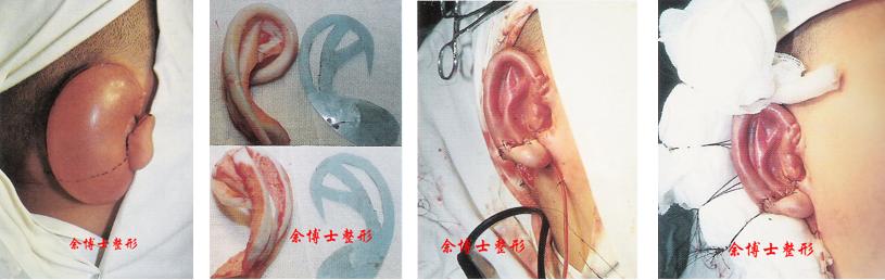 耳再造一期扩张手术过程,耳再造手术北京好还是上海好呢