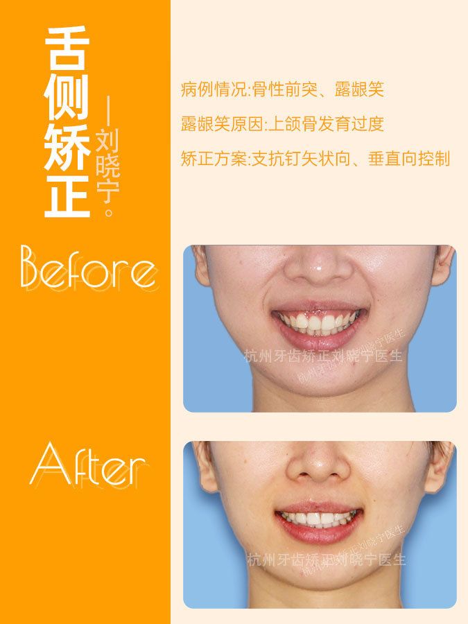 矫正牙齿如何改善露龈笑,矫正牙齿可以改善露龈笑吗