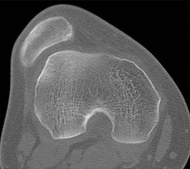 儿童习惯性髌骨脱位的手术治疗,儿童髌骨脱位怎么治疗最有效