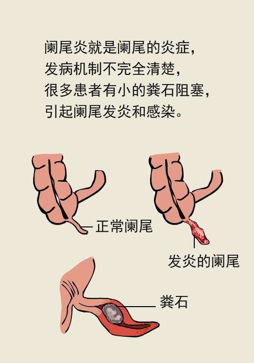 怀孕期间得了阑尾炎,怀孕期间得了阑尾炎一定要手术吗