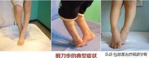 针刀治疗脑瘫面肌痉挛,针刀微创治疗脑瘫是真的吗