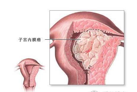 我都绝经12年了，怎么又出现流血了呢？这是咋回事？
