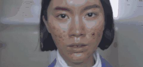 鼻子起痘都能挤出很多白色油脂,鼻子白色的痘痘挤出来有痘坑吗