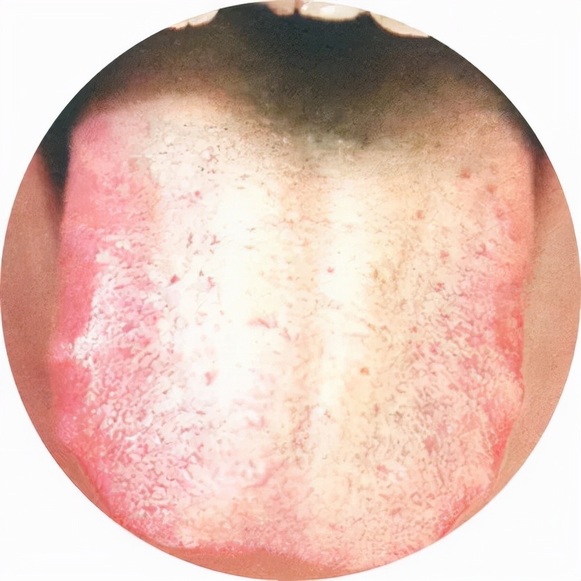 京城老中医提醒：黄腻苔不能以湿热一概而论，需用慧眼辨别虚实