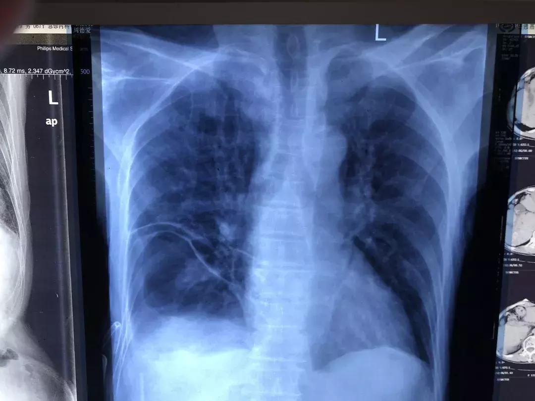 膈肌破裂修补术是大手术吗,膈肌缺损手术