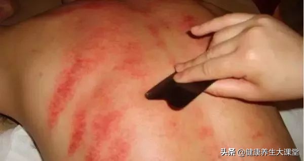 刮痧时出现的痧是啥样的,刮痧出痧消退过程中颜色变化