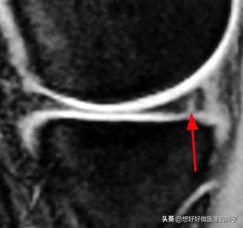半月板撕裂手术后怎么自己做康复,半月板撕裂手术最佳自愈方法