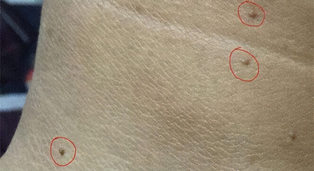 脖子腋下腹股沟长小肉粒怎么去除,腋下脖子上长小肉粒是什么原因