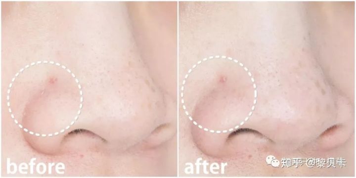 黑头去除神器排行榜,黑头粉刺清除强力推荐网红产品