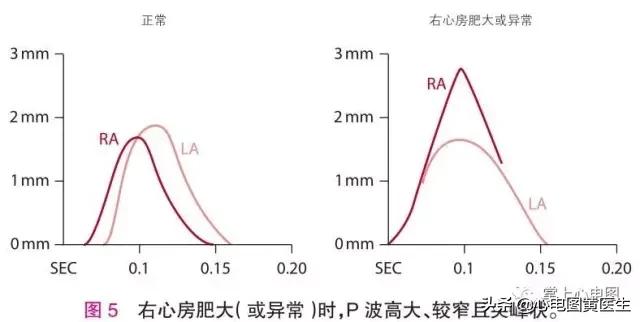 左右心室肥大发病原因,心脏肥大可以瘦回来吗