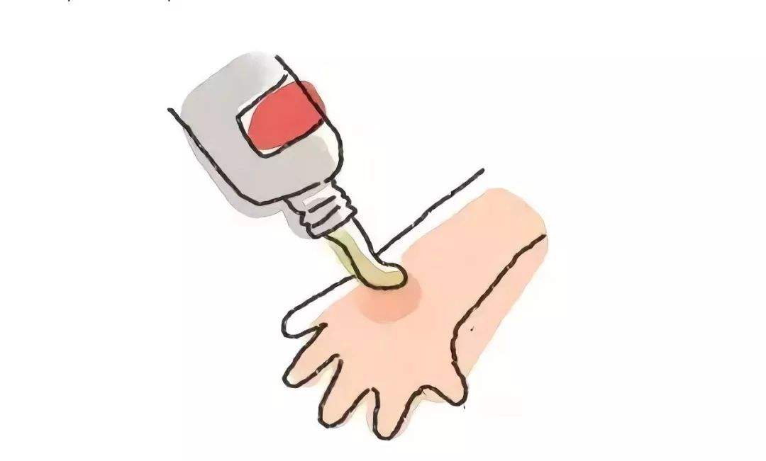 油炸烫伤治疗技巧,专治烧烫伤的验方分享简单实用