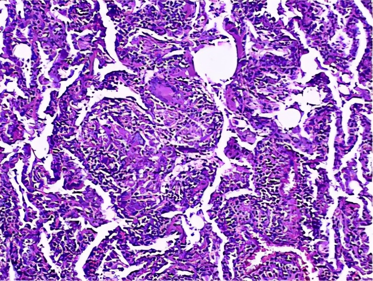 养鸽子造成皮肤真菌感染,养鸽子会得肺炎吗