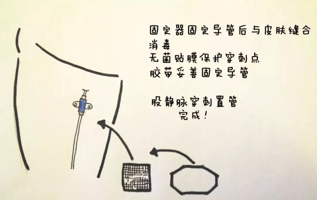 股静脉穿刺置管输液,股静脉穿刺置管术详细讲解