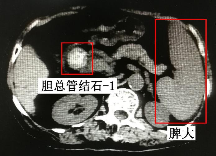 有乙肝大三阳又有胆结石怎么治疗,乙肝小三阳胆囊结石吃什么中成药