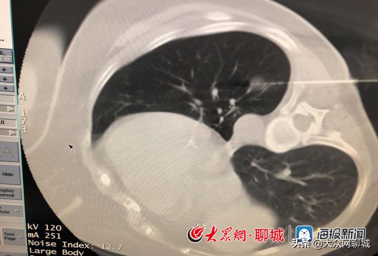 聊城退役军人医院能做手术吗,聊城市人民医院射频消融术