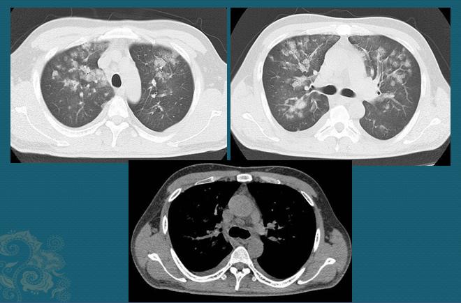 17岁肾炎，30岁尿毒症咳血，医生说有些病要尽早去大医院，能救命