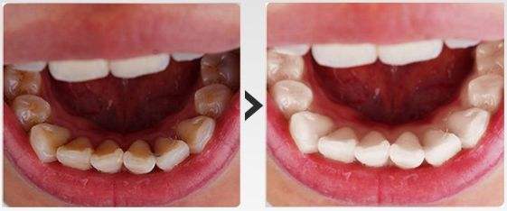 刘涛是全口瓷牙,演员刘涛的一口烤瓷牙多少钱