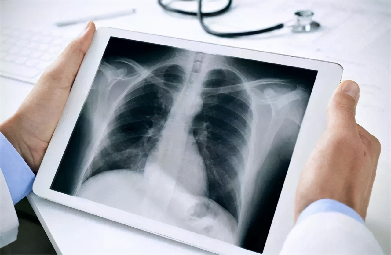 肺癌晚期临走前两个月的症状,70岁老人肺癌晚期最好情况