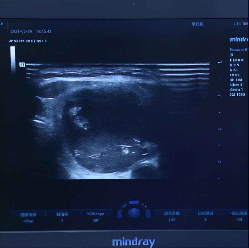 甲亢相关案例视频,亚临床甲亢怎样快速自愈