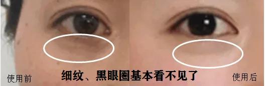 去眼纹去黑眼圈用什么方法,去眼袋眼纹公认最好用的土方法