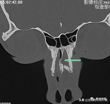「鼻骨彩图」鼻骨CT解剖及骨折影像学诊断