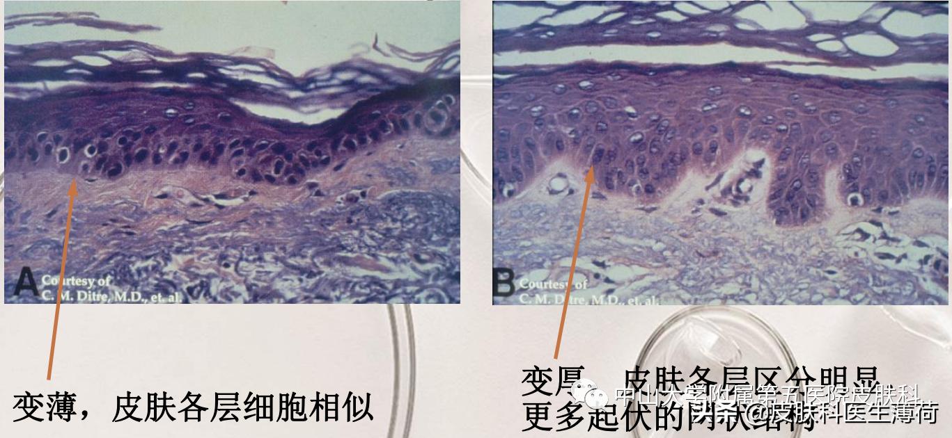果酸换肤医生讲解,医生不会告诉你的秘密水杨酸