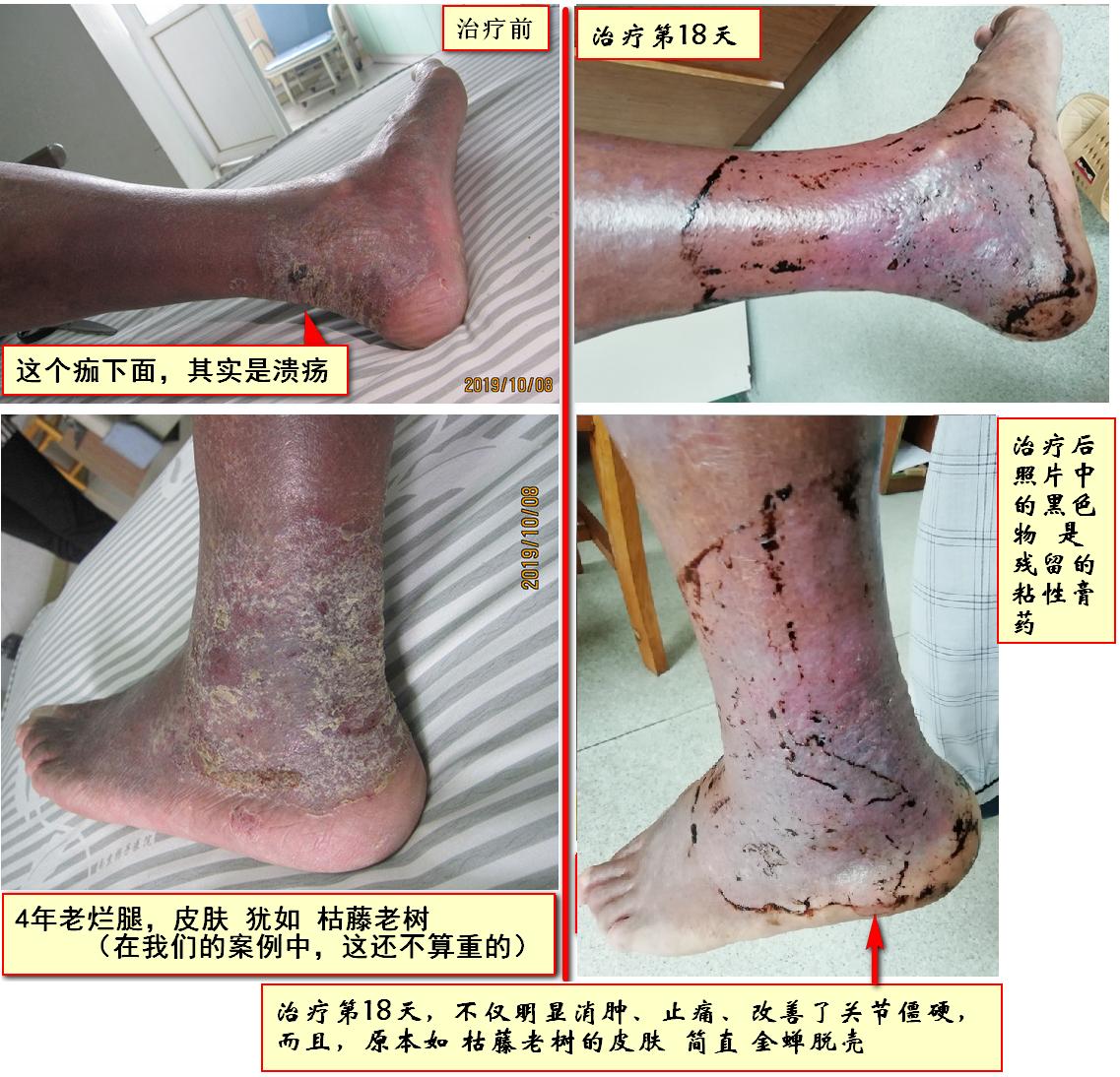 小小外伤4年8次住院，三甲医生举案说法：健康无小伤，手术须慎行