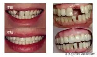 只剩残根的牙真的能补救吗,烂的只剩下黑色残根的牙怎么处理