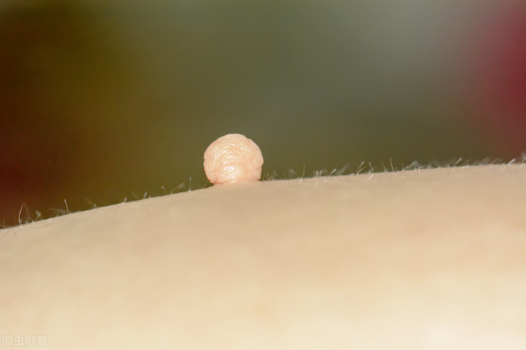 脖子和腋窝长小肉粒是什么原因,脖子和腋下长小肉粒会自己消失嘛