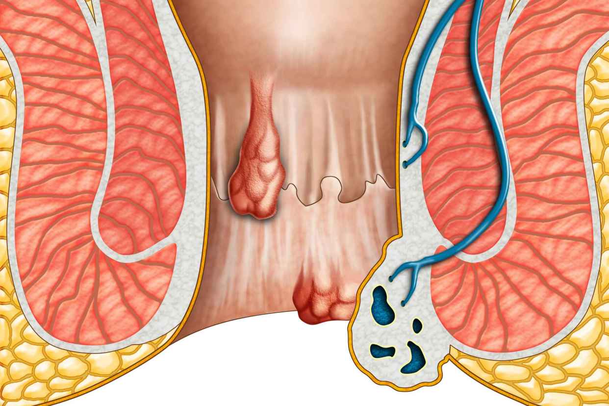 内痔最怕的一个偏方和土方法,一招治内痔