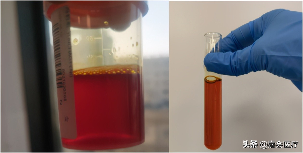 尿液变绿,吃了药尿液变绿是怎么回事