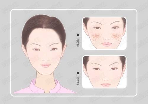 果酸换肤对哪种痘坑有效,果酸换肤对脂肪粒有效吗