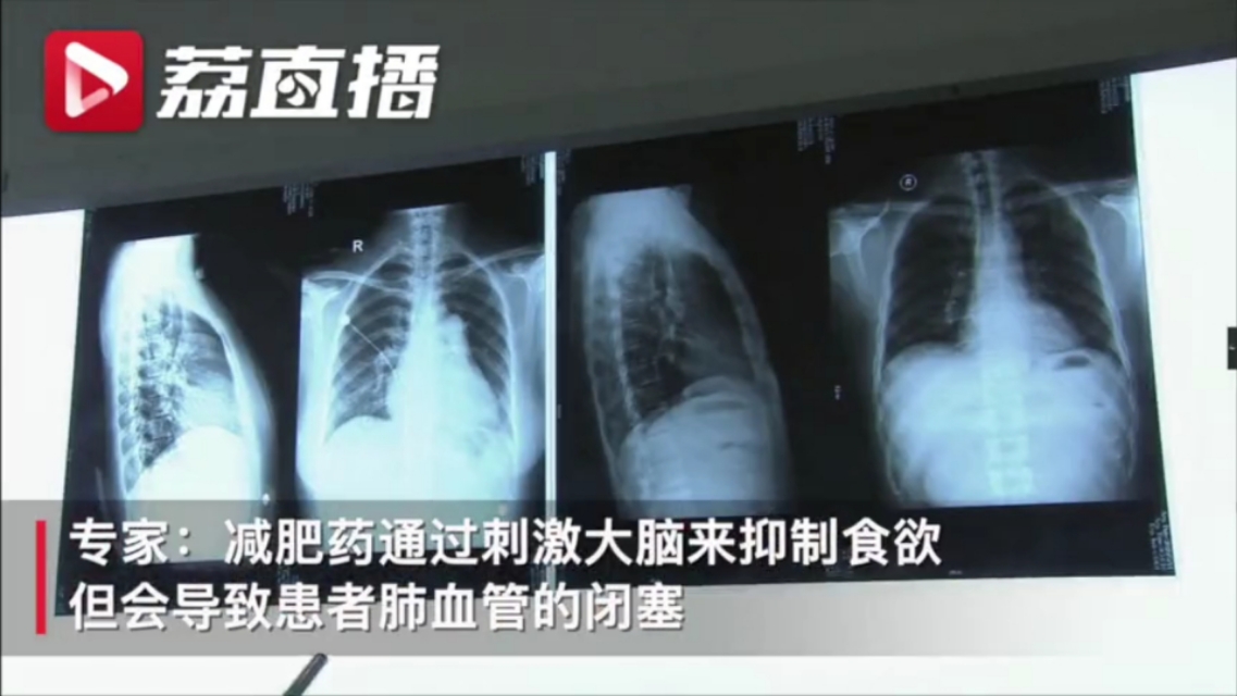 十年吃了三十种减肥药,10年吃三十多种减肥药