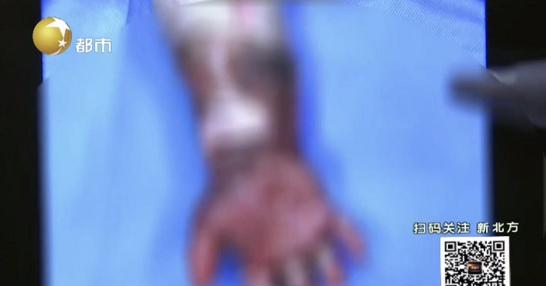 一岁宝宝被开水烫伤后皮肤发红,60度的水烫伤婴儿皮肤怎么办