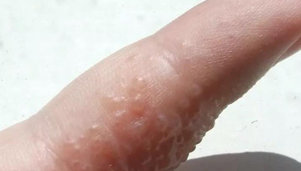 痒到怀疑人生的神经性皮炎,痒的要命的汗疱疹