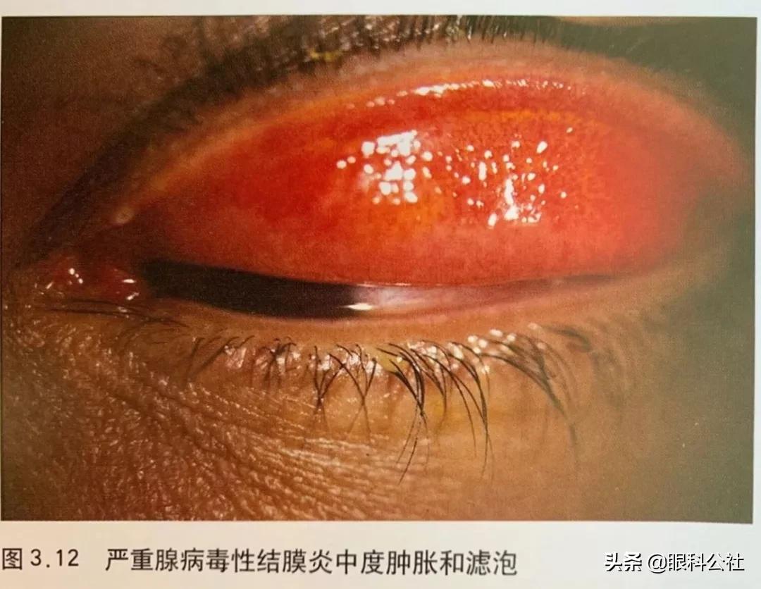 春季结膜炎的6大表现症状,疫情期间如何防结膜炎发生