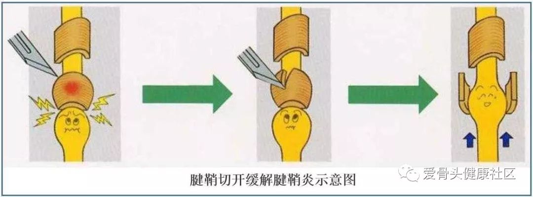 弧刃针一次搞定腱鞘炎,腱鞘炎手腕疼一招搞定