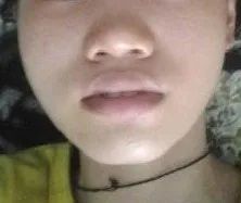 鼻头缩小鼻翼缩小前后对比图,鼻头缩小跟缩小鼻翼有区别吗