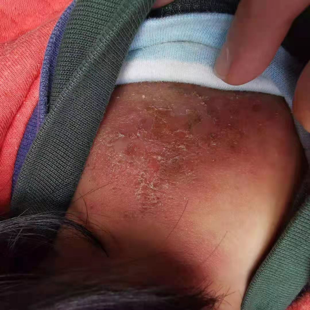 传染性软疣儿童怎么治可以断根,儿童脸上长了传染性软疣怎么办